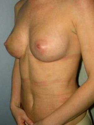 Lipotransfer Breasts