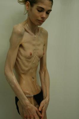 Anorexic Girls